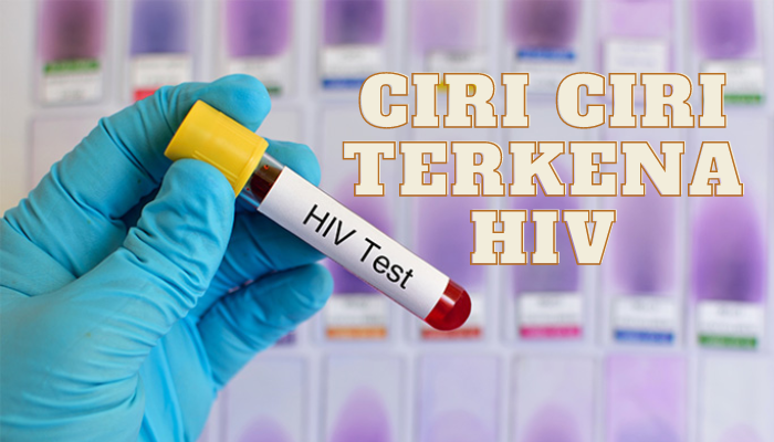 Ciri Ciri Terkena Hiv